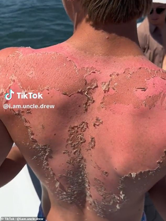 Taking peeling to a whole new level, @i.am.uncle.drew shared a clip showing swathes of skin hanging of a man's red back, exposing pink flesh underneath