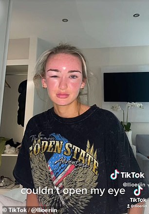 The holidaymaker revealed she had a similar result to Ellie after being blasted by too much skin, and she couldn't open her eyes as they were so swollen
