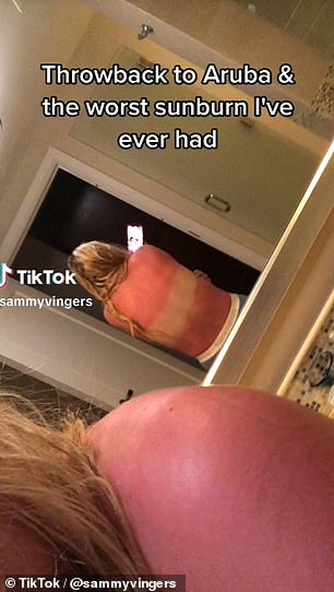 Samantha Vingers reveals in her sunburn-themed TikTok that she called the hotel doctor while she was in Aruba, because her skin was so painful