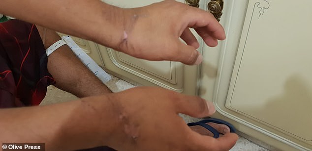 Despite begging to go to hospital it wasn't until 9.20am that three Guardia agents returned and took Mr Torres to a GP in Estepona, where the doctor told the officers he had to be taken to hospital urgently (Pictured: Mr Torres's scraped wrists after being placed in handcuffs)