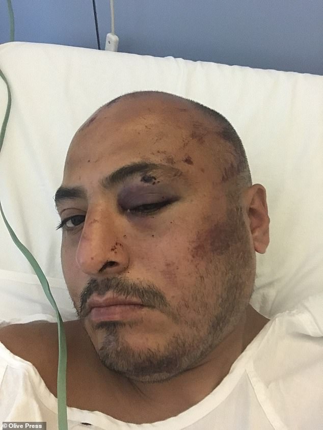 Diego Armando Torres, 37, insists he was punched and kicked by six Guardia Civil agents on a Friday night, after being pulled over for a routine traffic stop (Pictured: Mr Torres' facial injuries following alleged attack by police)