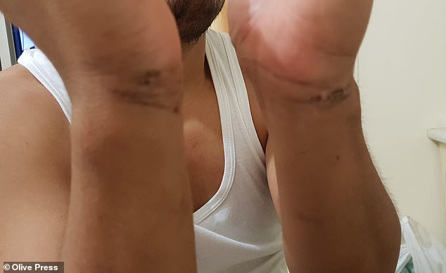 Disturbing pictures appear to show cuts and bruises caused by handcuffs placed on Mr Torres by Guardia Civil officers